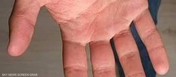 معلومه طبيه عن تصلب الشرايين