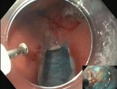 المجلة العلمية للجمعية الأمريكية للمناظير تختار حاله من مصر للنشر كغلاف لعدد يناير ٢٠٢٥