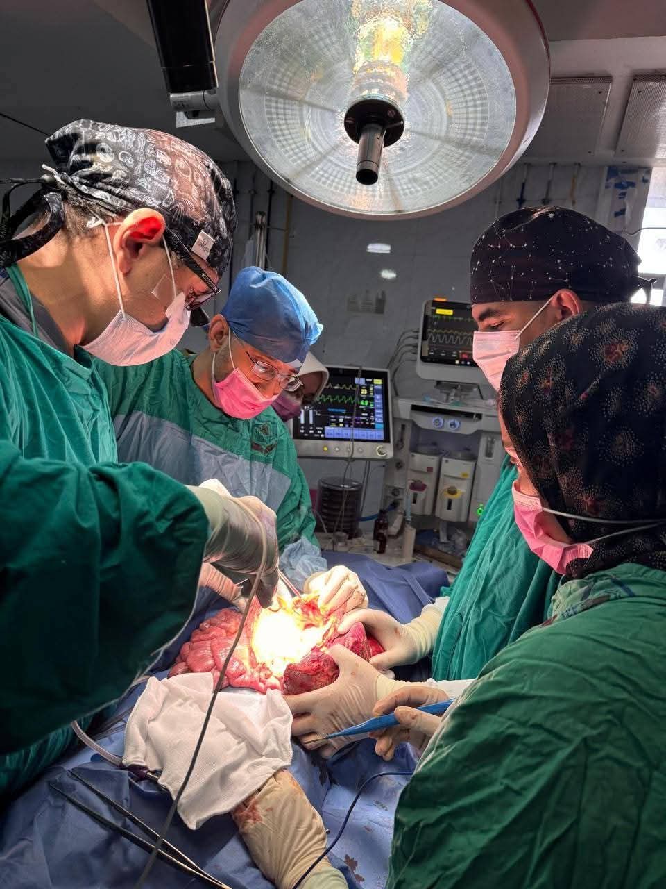 فريق طبي بقسم جراحة الأطفال بمستشفى الأطفال بجامعة أسيوط ينجح في إنقاذ حياة طفل مصاب بارتفاع ضغط الوريد البابي نتج عنه تضخم شديد بالطحال