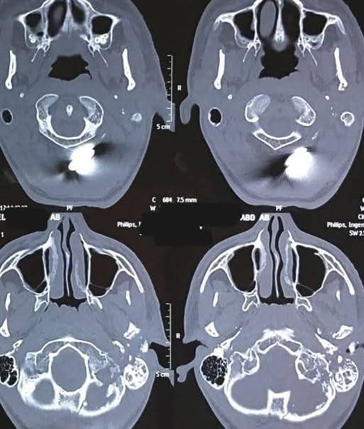 فريق طبي بقسم جراحة الأنف والأذن والحنجرة بالمستشفى الرئيسي بجامعة أسيوط يعيد الأمل لشاب بعد إصابته بطلق ناري نتج عنه شلل بالوجه