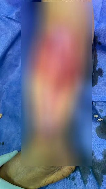 فريق طبى بقسم جراحة العظام  بمستشفى سوهاج الجامعى ينجح فى استئصال ورم نادر يزن 1.5 كيلو