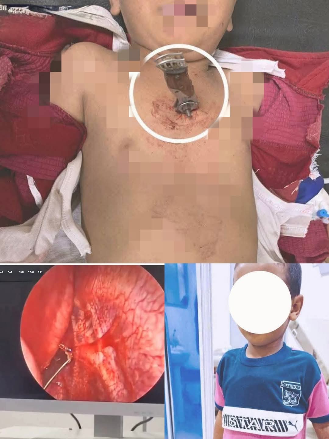 نجاح باهر لمستشفى سوهاج الجامعي في إنقاذ طفل من موت محقق إثر طعنة نافذة بسكين في قلبة 